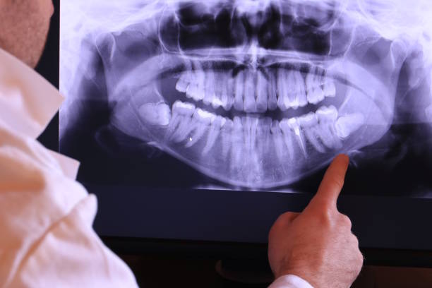 Best Emergency Wisdom Teeth Removal in Reedsville, WI